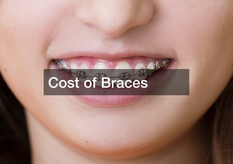 Cost of Braces